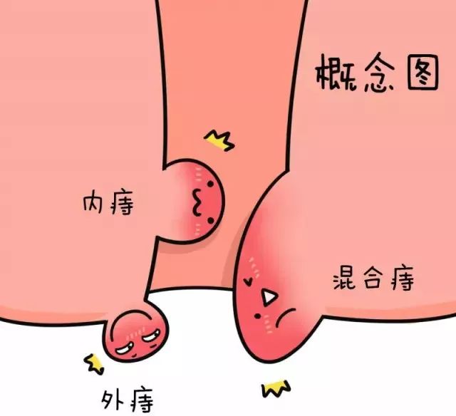 诱发痔疮形成的原因很多,既有自身生理结构上的原因,又有外部的原因